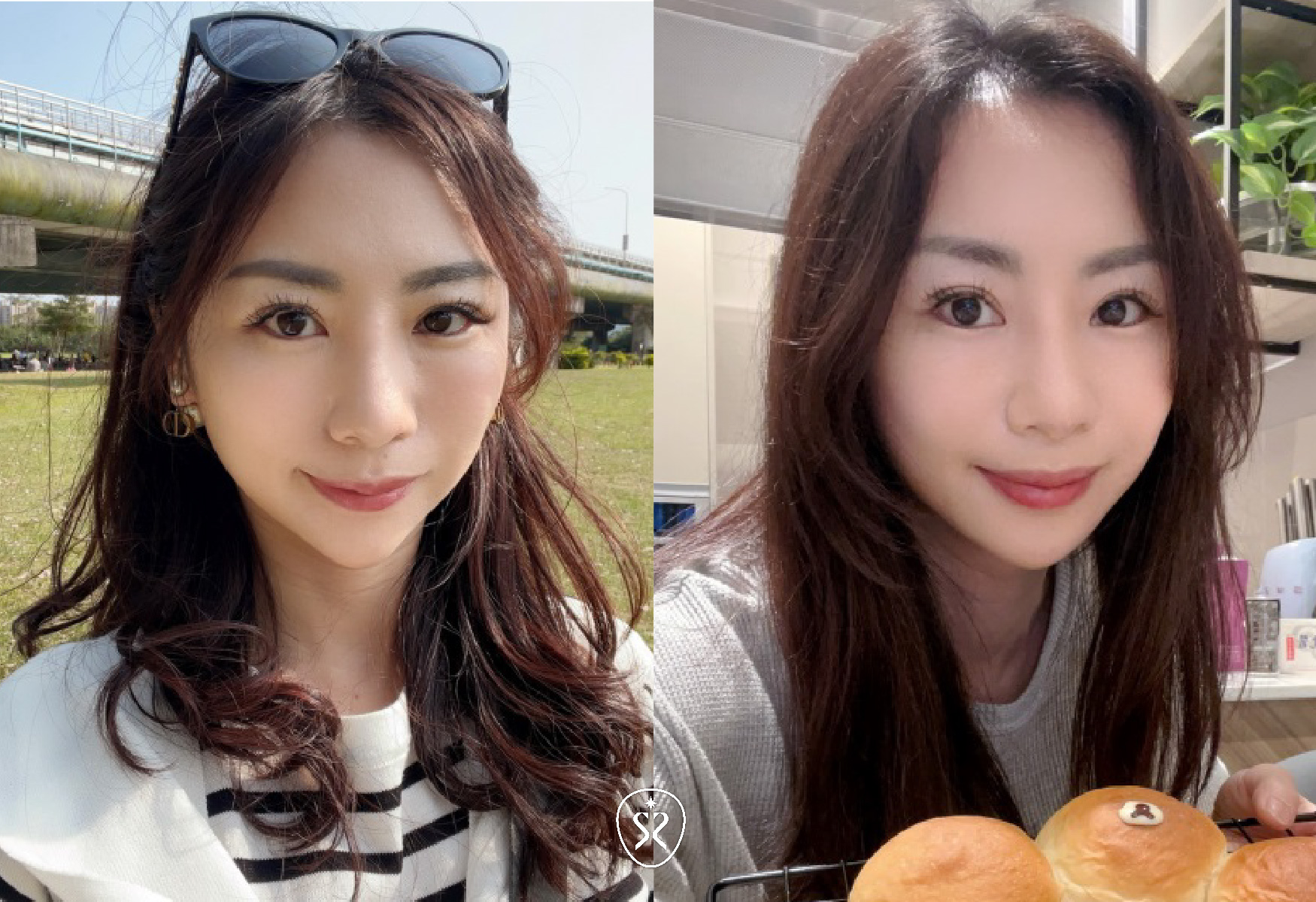 【玻尿酸】星采皮膚專科診所(古亭)-不再焦慮！輕鬆獲得一個順眼的自己 -小雯媽咪愛漂亮